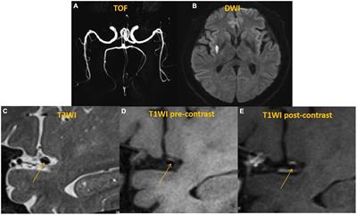 Characteristics of culprit intracranial plaque without substantial stenosis in ischemic stroke using three-dimensional high-resolution vessel wall magnetic resonance imaging